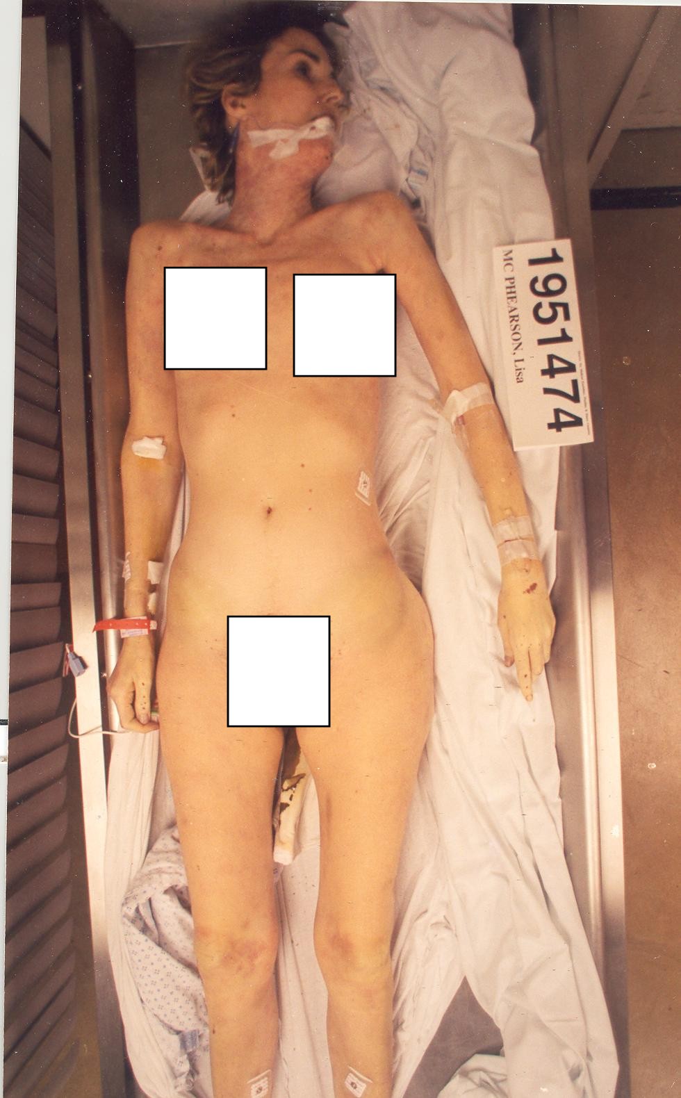 Autopsy Photos of Lisa McPherson