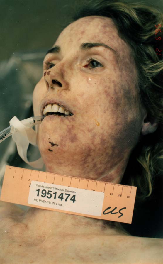 Autopsy Photos of Lisa McPherson.